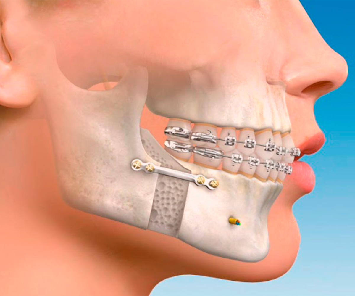 Cirugía Maxilofacial